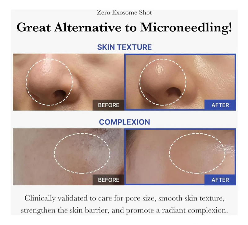 Sérum facial com microagulhamento Zero Exosome Shot 2000ppm e 7500ppm